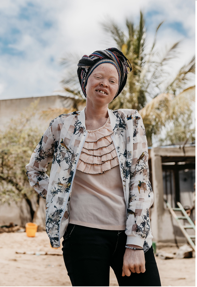 A young woman with albinism stands in a sunny courtyard, squinting against the sun and smiling slightly.