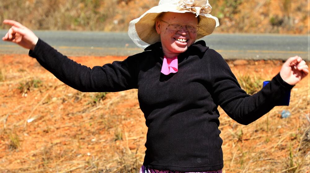 Stella Chiwaka, 28, has suffered stigmatization throughout her life for being born with albinism. © UNFPA Malawi/Leticia Nangwale